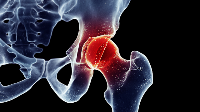 Principais informações que você precisa saber sobre a cirurgia de artroplastia do quadril